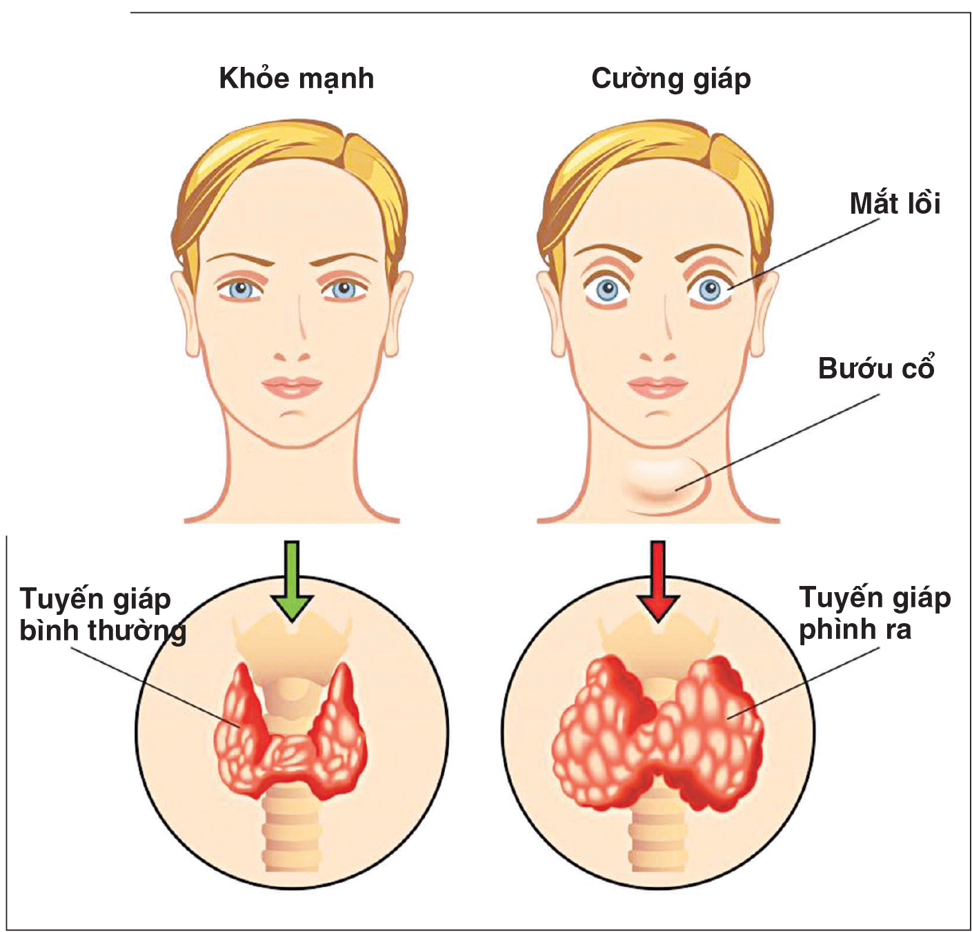 4. Biến chứng của bệnh bướu cổ