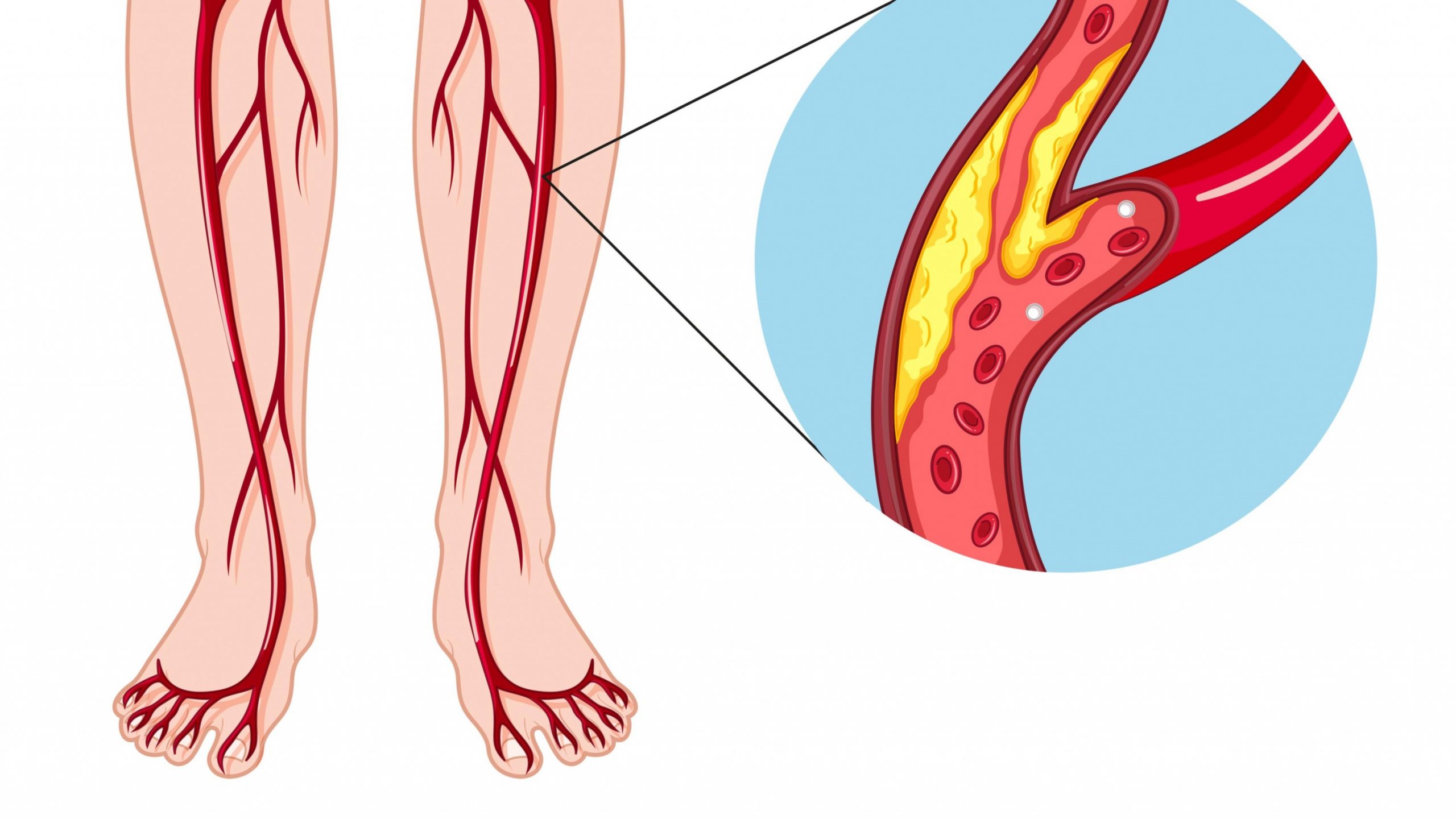 Bệnh mạch máu ngoại vi - Hội Nội tiết & Đái tháo đường Việt Nam
